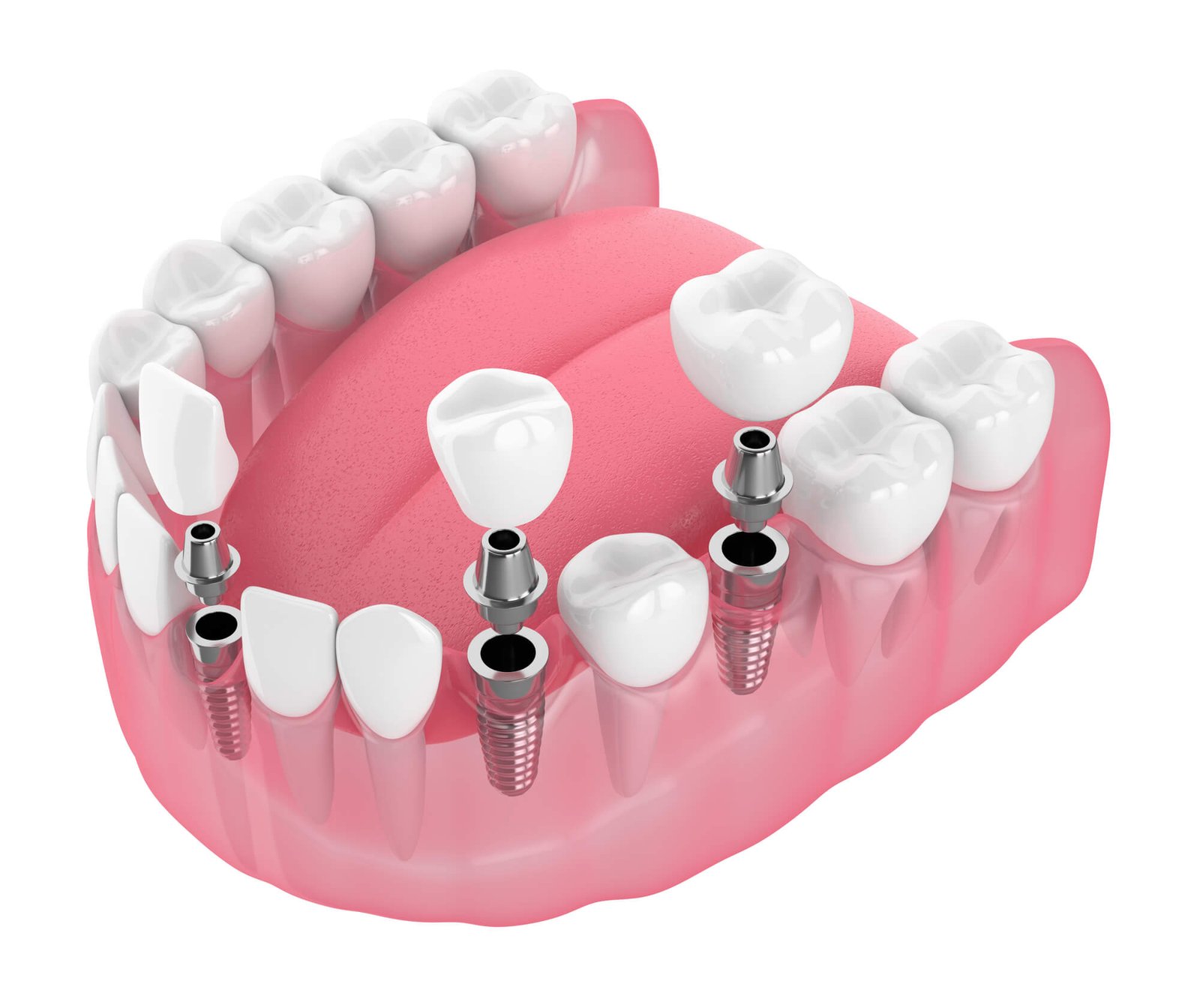 why-are-dental-implants-so-popular-tamiami-dental-center