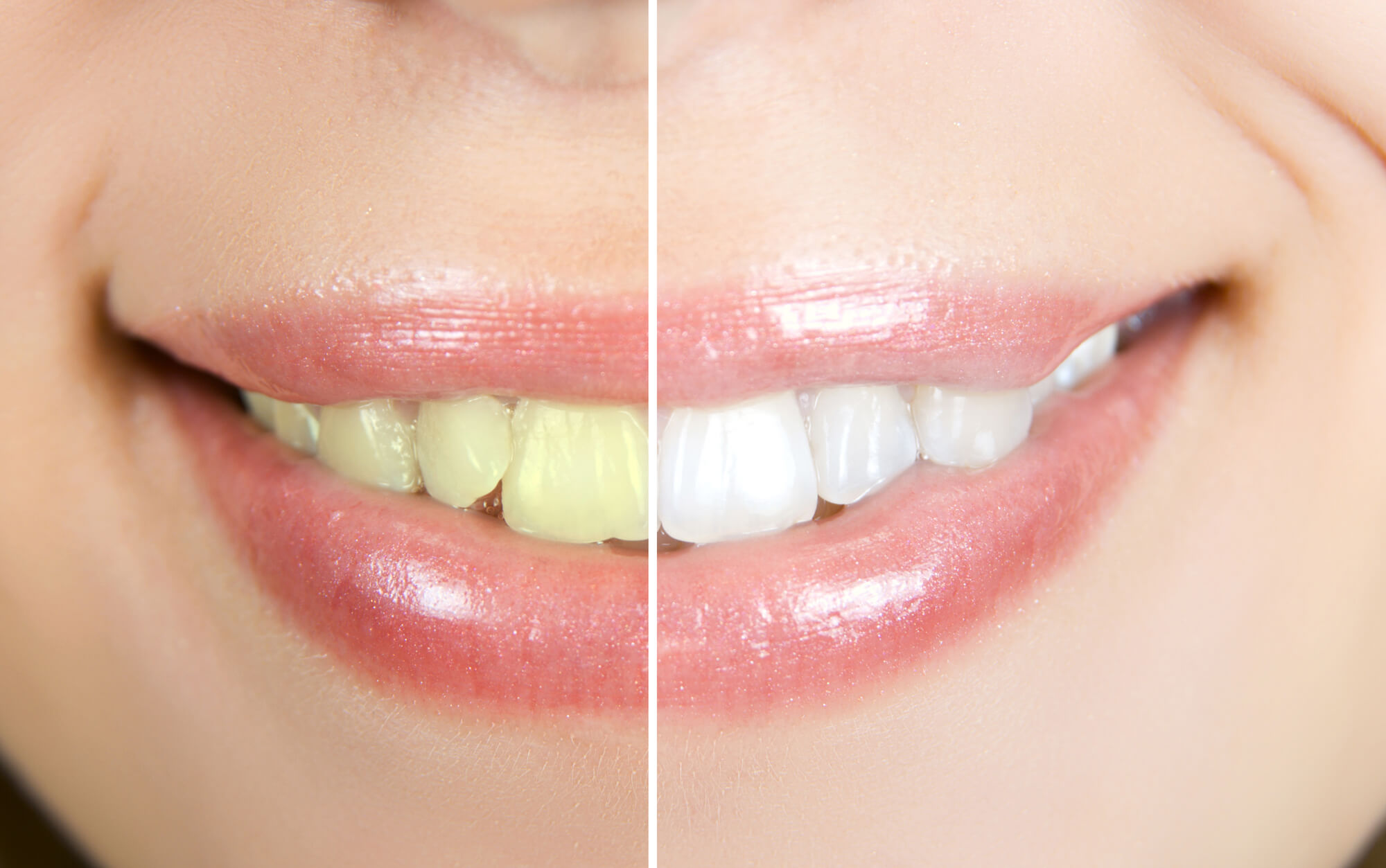 close up photo of before and after teeth whitening in Tamiami