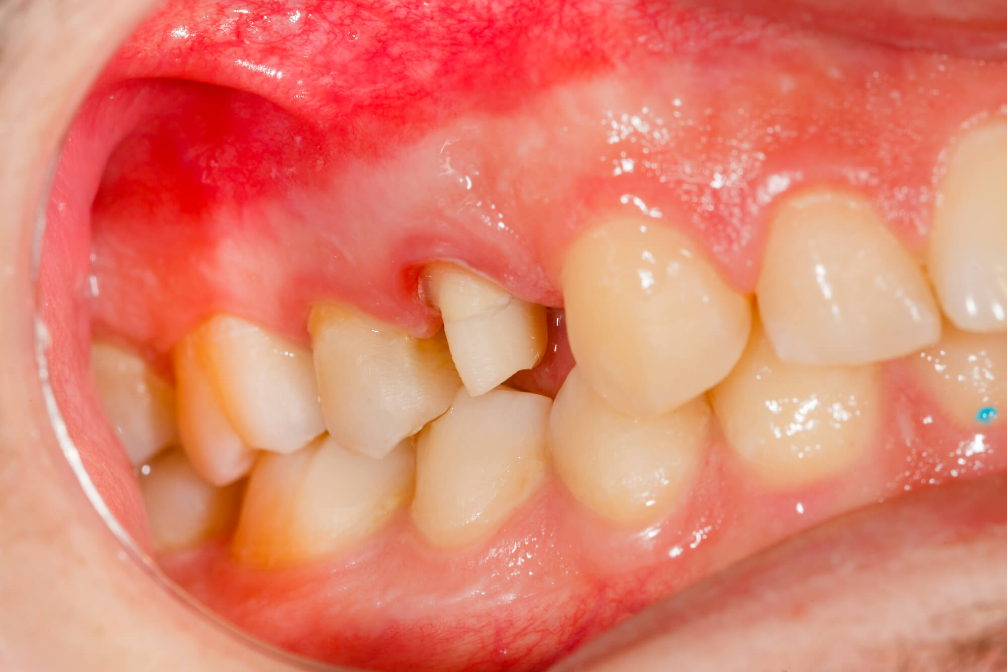 swollen gums in need of Periodontics in Miami