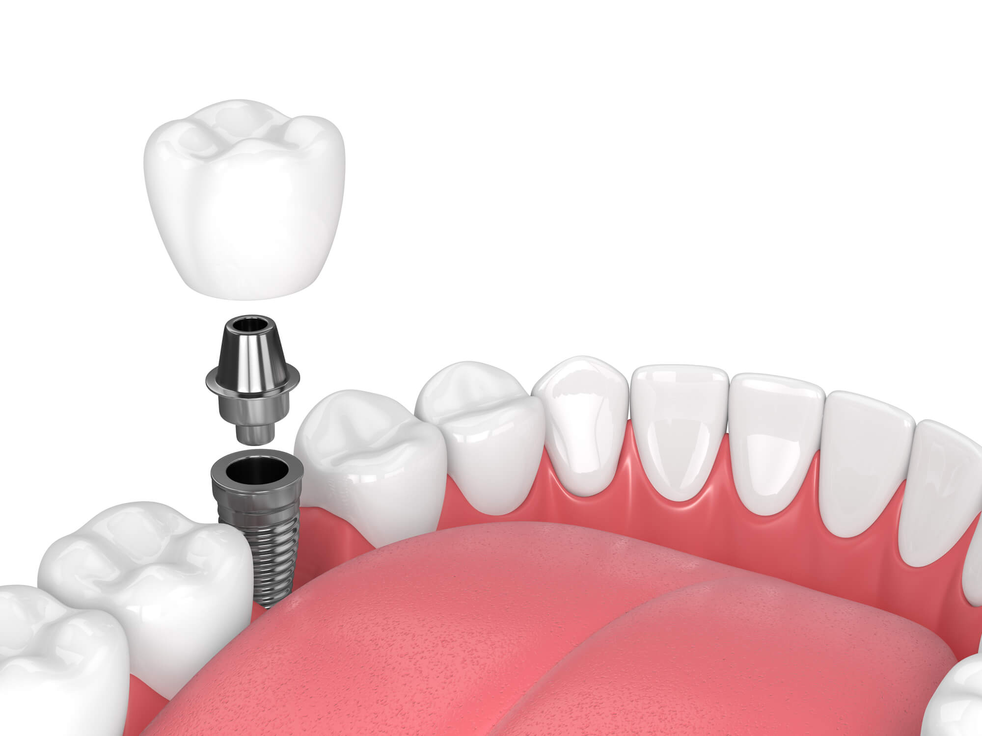 3D render of Dental implant miami fl