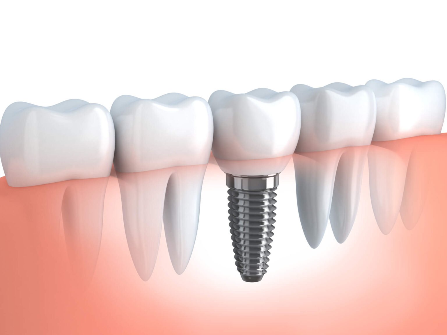 Demystifying Dental Implant Placement - Tamiami Dental Center